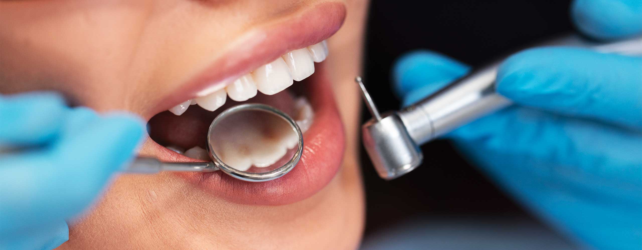 Odontoiatria conservativa endodonzia. Dottor Andrea Albani dentista a Rimini